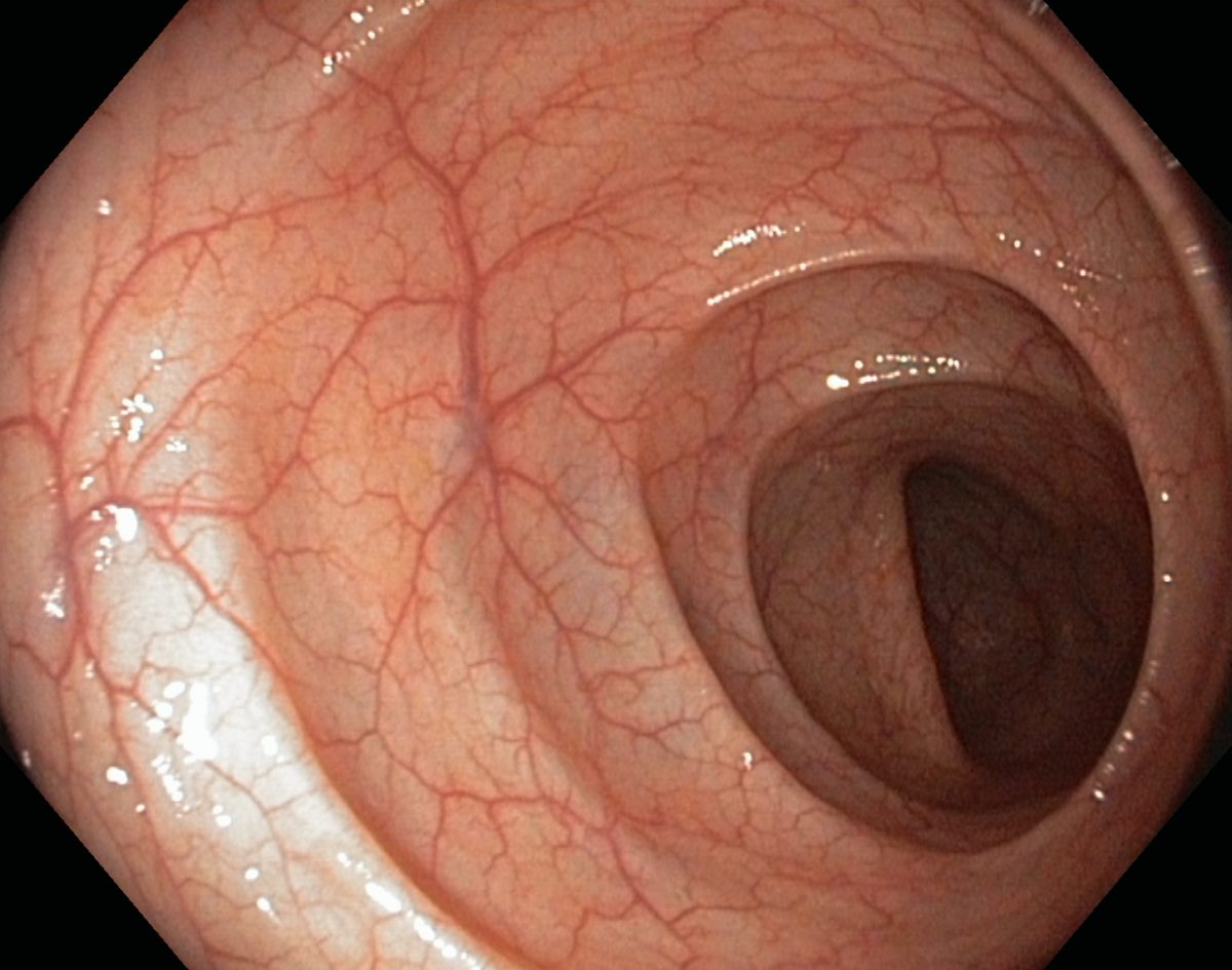 Endoscopia digestivă inferioară (colonoscopia)